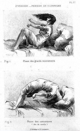 P. Richer, J.-M. Charcot, Études cliniques sur l P. Richer, J.-M. Charcot, Études cliniques sur l