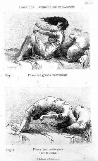 P. Richer, J.-M. Charcot, Études cliniques sur l P. Richer, J.-M. Charcot, Études cliniques sur l